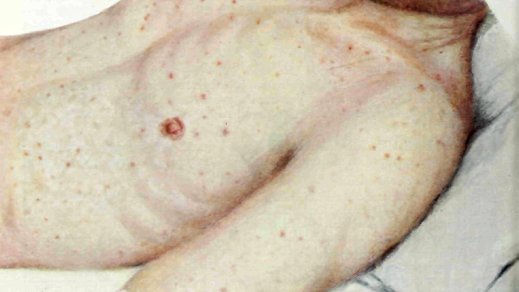 Lidské tělo s vyrážkou typickou pro skvrnitý tyfus